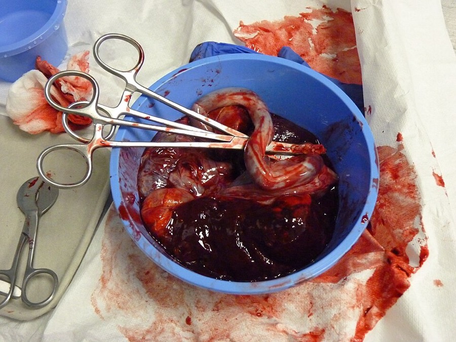 Ảnh minh hoạ Nhau Sản Phụ (Human placenta) 4